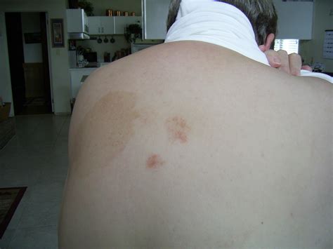 I Have A Skin Rash Mainly On My Back I Have Had All The A