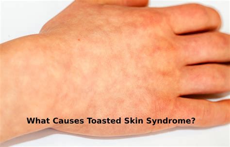 What Is Toasted Skin Syndrome Causes Symptoms And More
