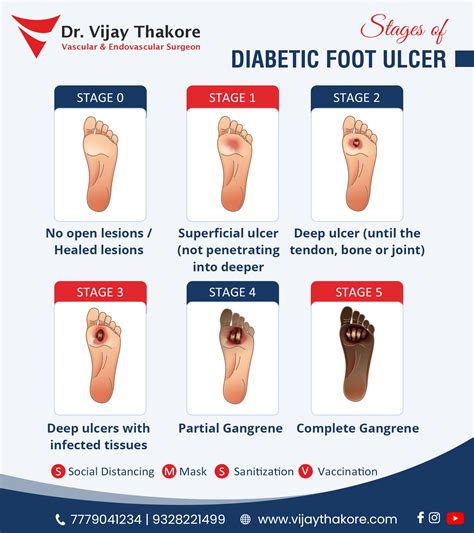 diabetic foot ulcer diabetic foot treatment doctor in vadodara dr vijay thakore