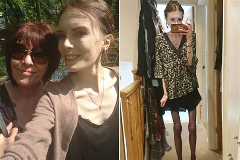 Student Developed Anorexia After Starving Herself To Fit Into