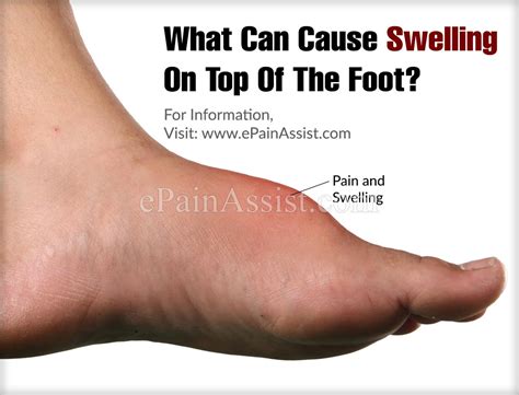 What Can Cause Swelling On Top Of The Foot