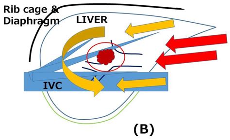 Cancers Free Full Text Laparoscopic Repeat Liver Resection