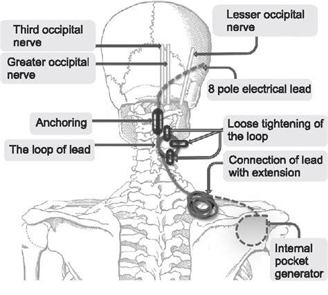 Figure 2 From Occipital Nerve Stimulation In A Patient With An