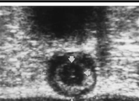Transverse Infracoccygeal Sonogram Of The Anal Sphincter Complex