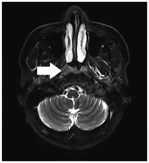 Initial Magnetic Resonance Imaging Mri Scan Of The Nasopharynx