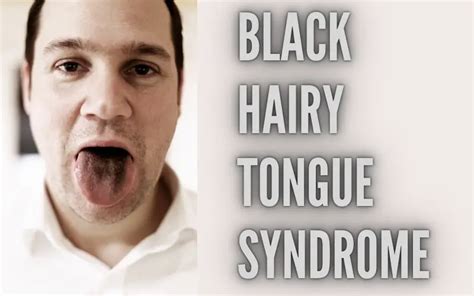 Black Hairy Tongue Syndrome 10 Facts To Enhance Your Understanding