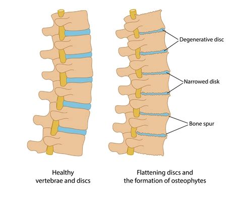 Degenerative Disc In Thoracic Spine