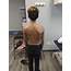 Back Pain Scoliosis  Motion Science Physiotherapy Clinic