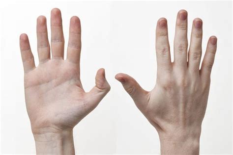 Finger Joint Inflammation Symptoms Diagnosis Cause And Treatment
