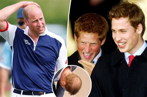 Prince Harry Calls Prince Williams Hair Loss Alarming In Memoir
