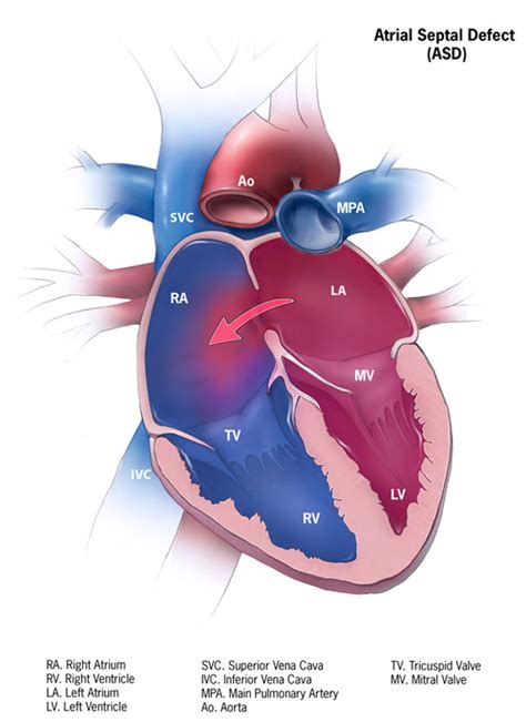 Atrial Septal Defect Facts Congenital Heart Defects