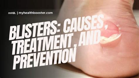 Blisters Causes Treatment And Prevention Myhealthbooster