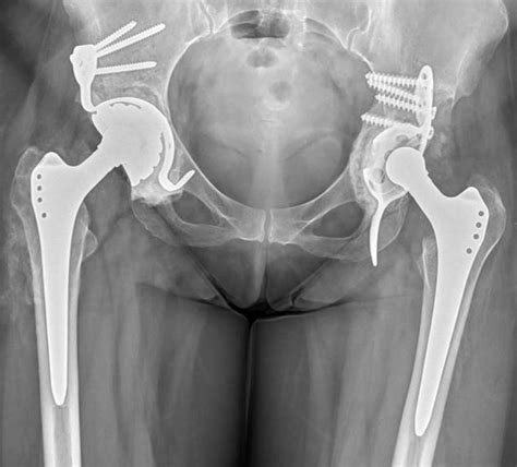 Changement de prothèse totale de hanche ISCO Institut Spécialisé de Chirurgie Orthopédique à