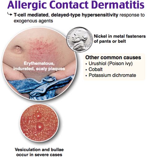 Rosh Review Allergic Contact Dermatitis Contact Dermatitis Dermatitis