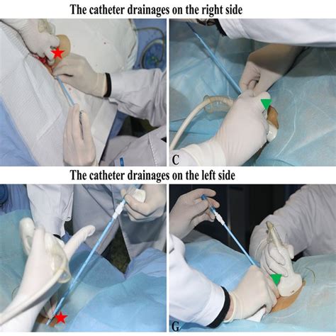 The Guidance Of Catheters Placement Under Apd And Pcd A Patient With