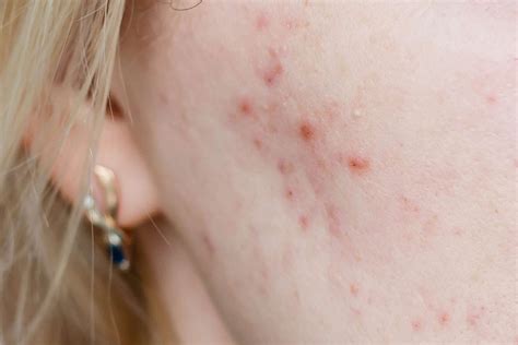 A Dermatologists Role In Cystic Acne Treatment