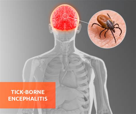 Tick Borne Encephalitis Labonline