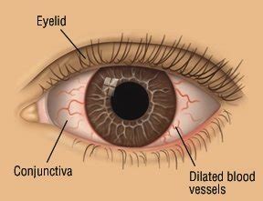 Conjunctivitis (pink eye) is an infection that can make your baby's eyes sticky and red. Pinkeye (Conjunctivitis) Guide: Causes, Symptoms and ...
