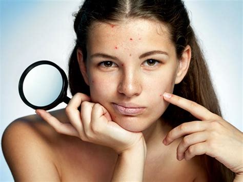5 Most Common Myths About Acne