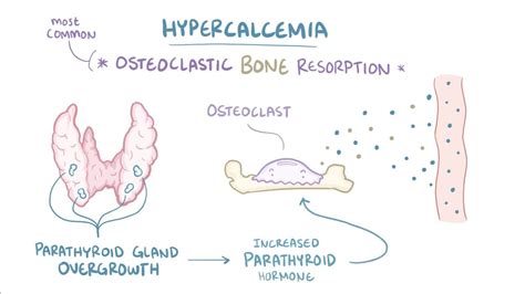 Hypercalcemia Video Anatomy Definition And Function Osmosis