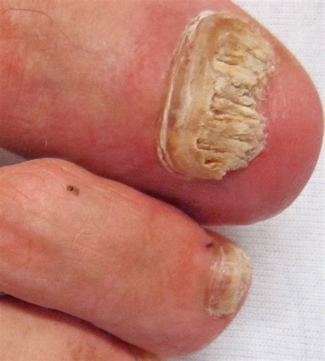 Fungal diseases are major causes of morbidity and mortality among the immunocompromised, including. Fungal Nails - Sale Podiatry