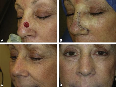 The Superiorly Based Bilobed Flap For Nasal Reconstruction Journal Of The American Academy Of