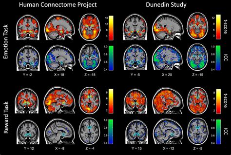 Duke Study On Fmri Brain Scans For Post Concussion Syndrome Detection