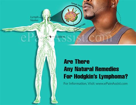 Are There Any Natural Remedies For Hodgkins Lymphoma