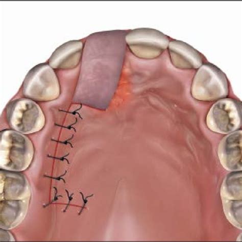 Pdf Soft Tissue Closure Of Grafted Extraction Sockets In The Anterior