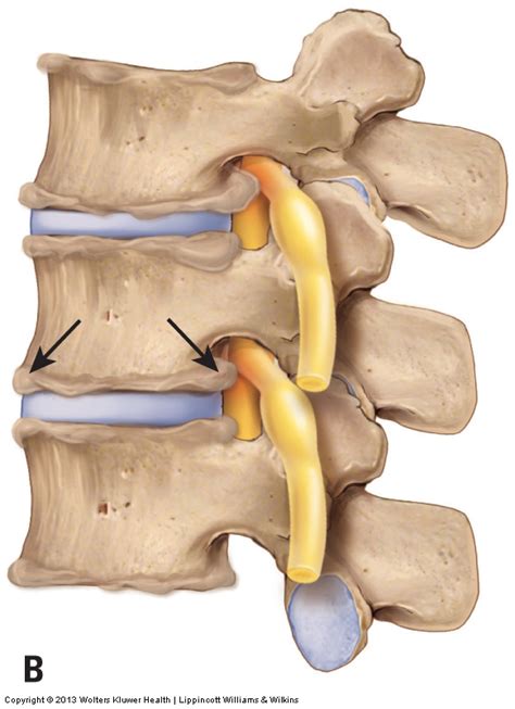 Osteoarthritis Degenerative Joint Disease Of The Cervical Spine