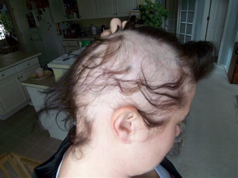 Medical Pictures Info Alopecia Areata