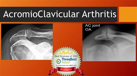 Acromioclavicular Arthritis Youtube