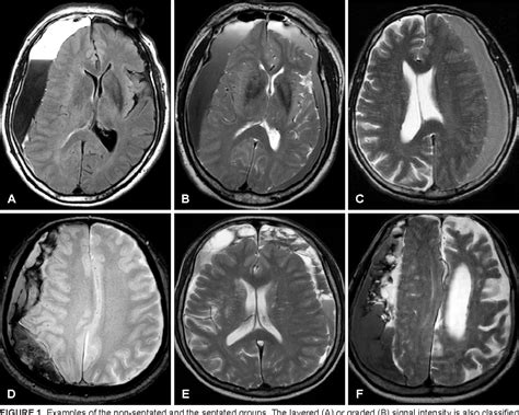 Figure 1 From Multiple Episodes Of Hemorrhage Identified In Mri Of