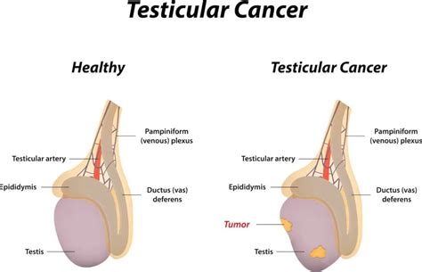 Testicular Cancer Symptoms Diagnosis Treatment Singapore