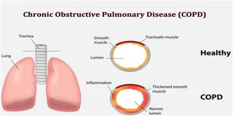 Chronic Obstructive Pulmonary Disease Causes Risk Factors And