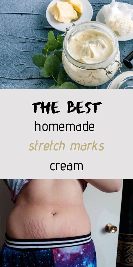Stretch Marks Cream With Shea Butter Best Wellness Guide Stretch