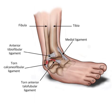 Ligaments Torn In A Lateral Ankle Sprain Ryde Natural Health Clinic