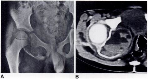 Imaging Of Pelvic Aneurysmal Bone Cyst A Plain Radiograph Shows