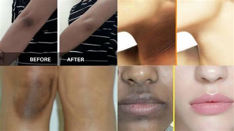 How To Remove Darkness Hyperpigmentation Dark Spots Konika