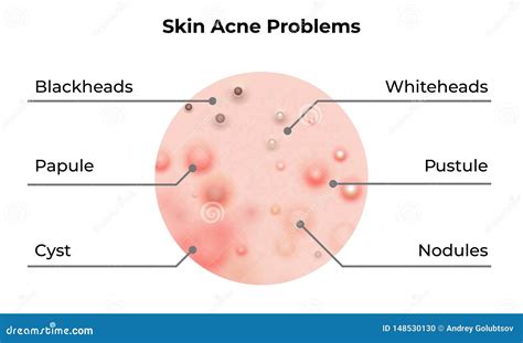 The Six Types Of Acne Infographic Cartoon Vector