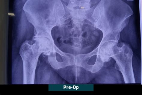 Primary Hip Replacement Surgery Ahmedabad Dr Rachit Sheth