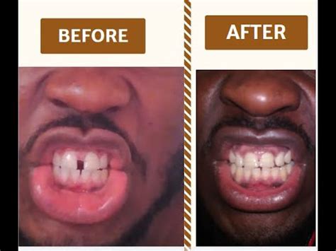 Rubber bands exert a carefully calibrated, precise amount of positive pressure on your teeth in accordance with your orthodontist's treatment. Close Teeth Gap in Only 8 Weeks at Home With Rubber Bands ...