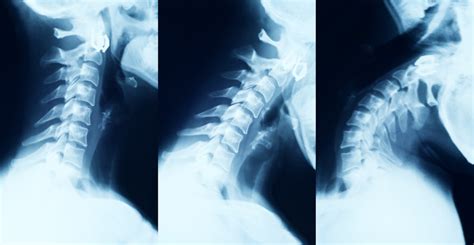 Cervical Instability Causes Best Treatment Options In 2023