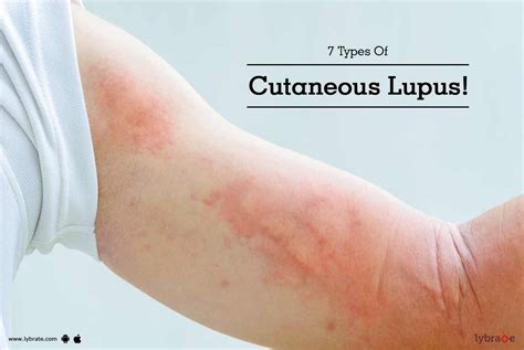 7 Types Of Cutaneous Lupus By Dr Yogesh Lybrate