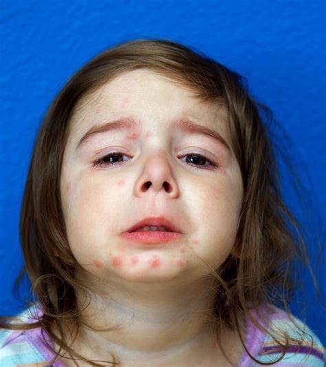 Psoriasis In Children Types Symptoms And Treatment