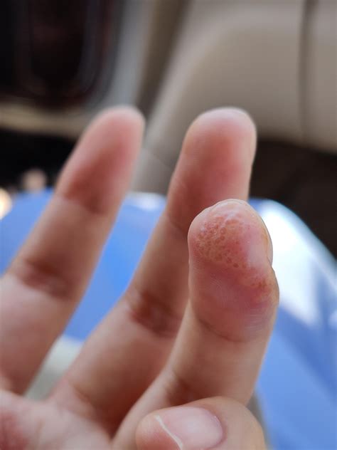 Fingertip Is Painfully Tingly From The Blisters Constantly Pressuring