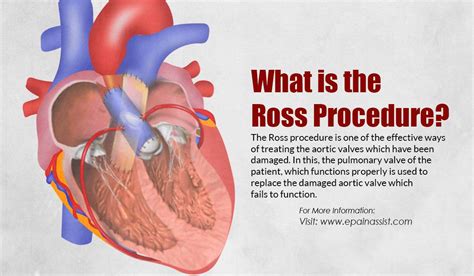 What Is The Ross Procedure