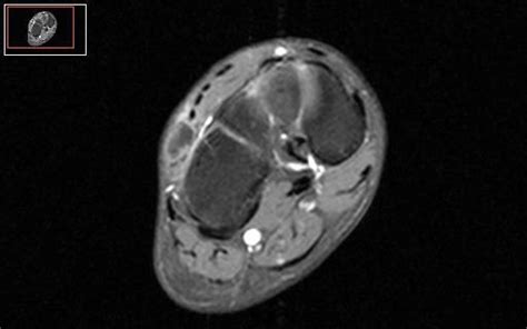 Ruptured Ganglion Cyst Of The Foot Mri Findings Eurorad