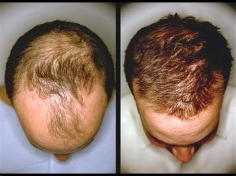 The oils can prevent numerous scalp and hair diseases as well. ginger garlic for hair growth by dimple d'souza - YouTube