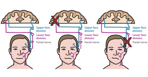 Maybe you would like to learn more about one of these? The OD's Introduction to Bell's Palsy | Eyes On Eyecare